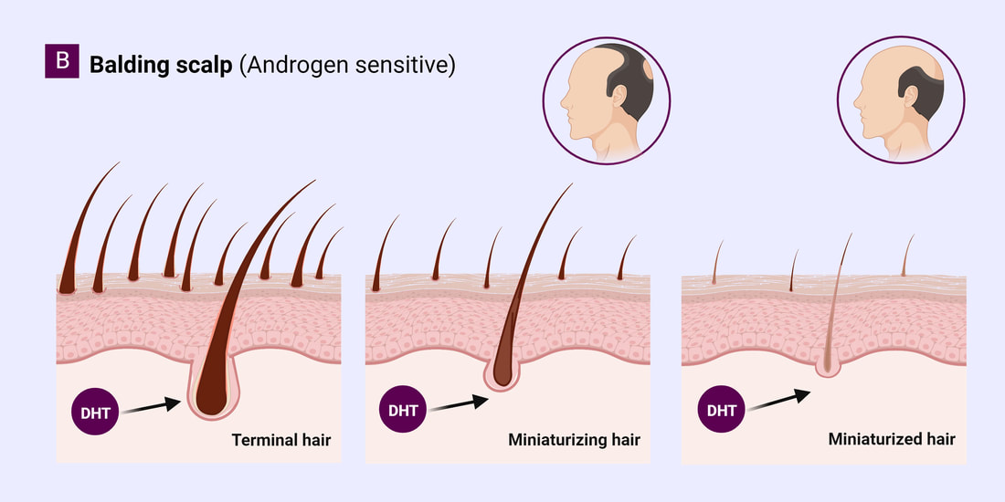 androgenetic alopecia, hair loss, pattern hairloss male type
