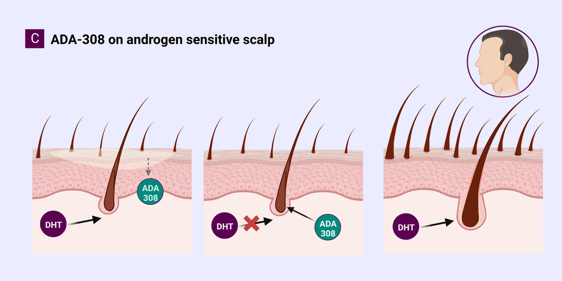 treatment for androgenic alopecia, finasteride 1 mg, minoxidil