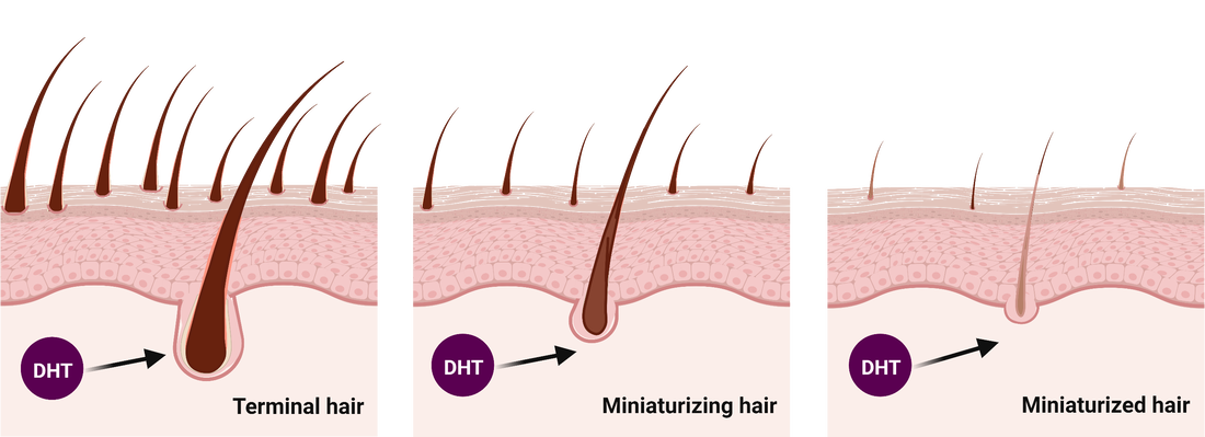 hair loss, androgenetic alopecia, alopecia