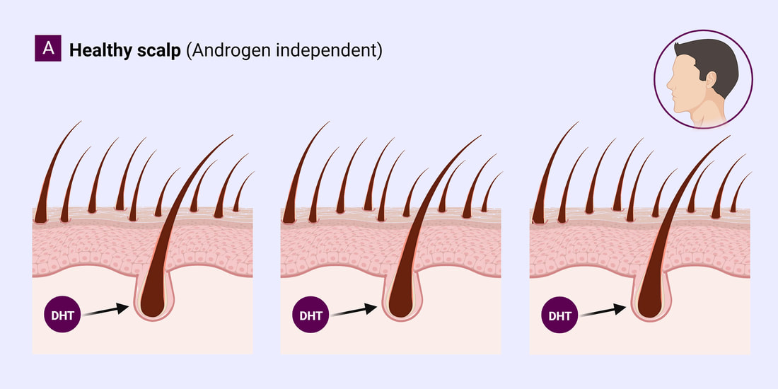 treatment for hair loss, treatment for androgenic alopecia